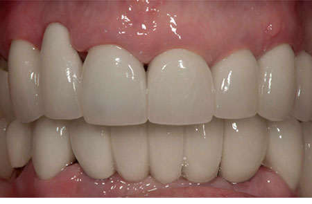 Solution: Implants and Crowns