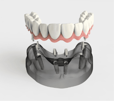 Dental Implants Crown Point, IN