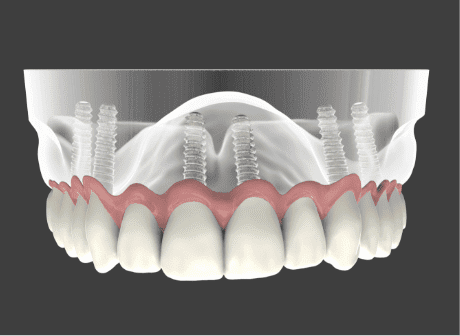 Dental Implant Crown Point, IN
