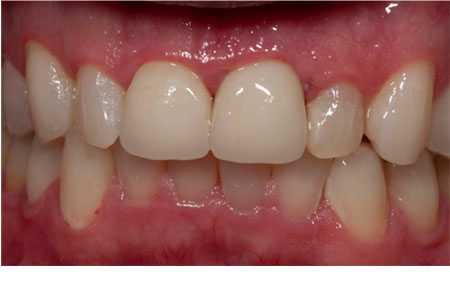 Solution: Bleaching, Porcelain Crowns and Composite Bonding