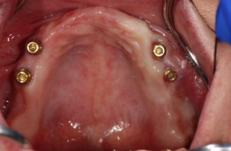 4 Implant Retained Maxillary Denture - BEFORE