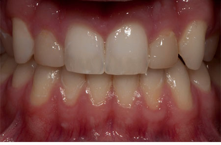 Underdeveloped (Peg) Lateral Incisors with Old Bonding