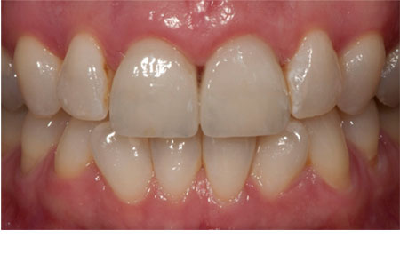 Solution: Crown Lengthening and New Porcelain Crowns