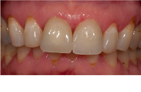 Solution: Chairside Bleaching and Porcelain Crowns