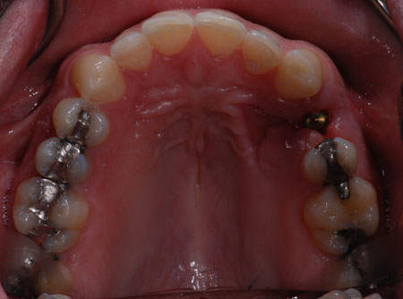 Extraction and Immediate Implant Placement