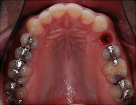 Soft Tissue Sculpting with Temporary Restoration