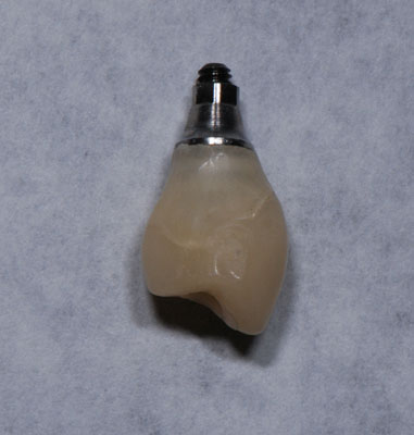 Temporary Restoration