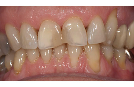 Worn and Discolored Central Incisors and Composite