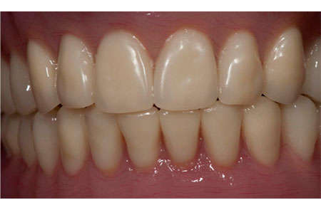 Solution: Implant retained lower denture