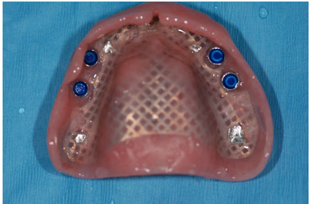 Solution: Implant retained lower denture