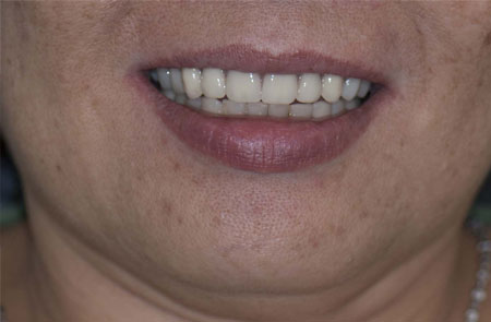 Central Incisors Fractured and Missing