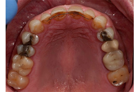 Worn Teeth