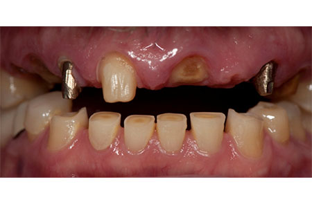 Failed Upper Teeth and Worn Lower Front Teeth