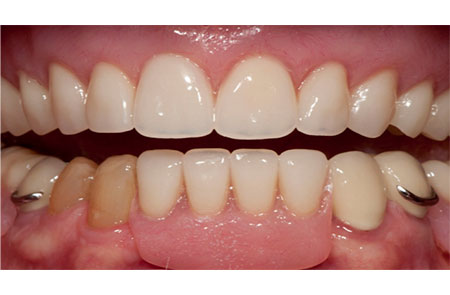 Solution: Upper Denture, Lower Crowns and Removable Partial Denture