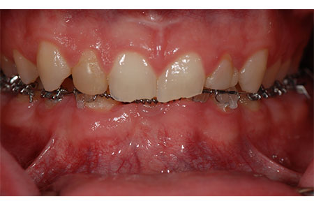 Missing and Malformed Permanent Teeth and Excessive Overbite