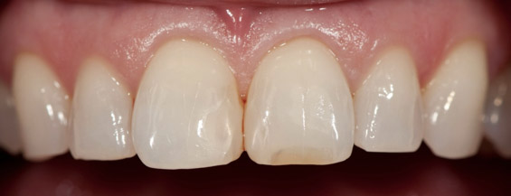 Failing composite bonding
